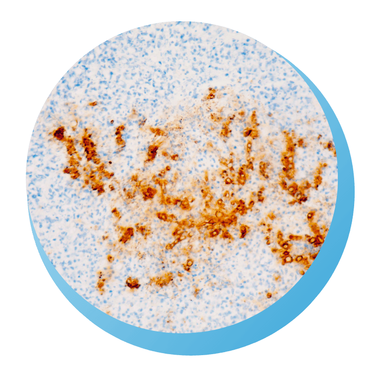 Microscopic view of an immunohistochemistry-stained tissue sample showing brown-stained cells against a blue background